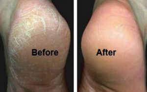 कुर्कुच्चा फुट्ने समस्या चट् पार्ने अपनाउनुहोस यी घरेलु बिधीहरु,